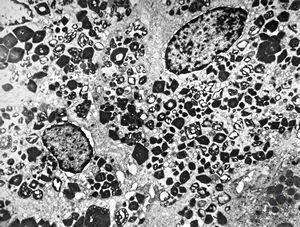 M,58y. | crystalline inclusions in hepatocyte after unknown medication M,58y. | crystalline inclusions in hepatocyte after unknown medication